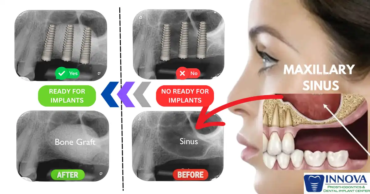 Innova-Prosthodontics-implant-sinus-lift1