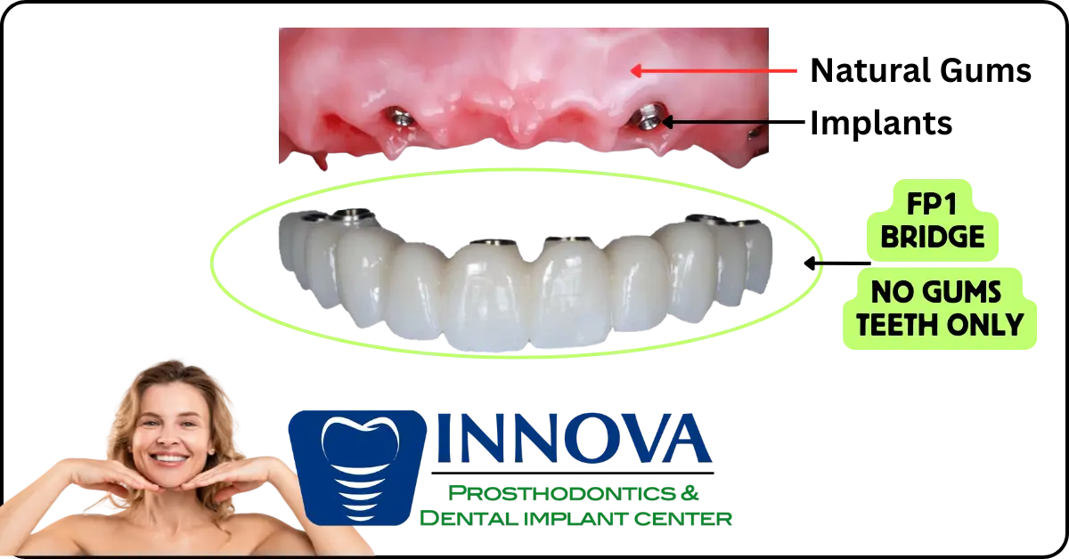 Innova Prosthodontics-What is an FP1 Full Arch Implant Restoration Bridge