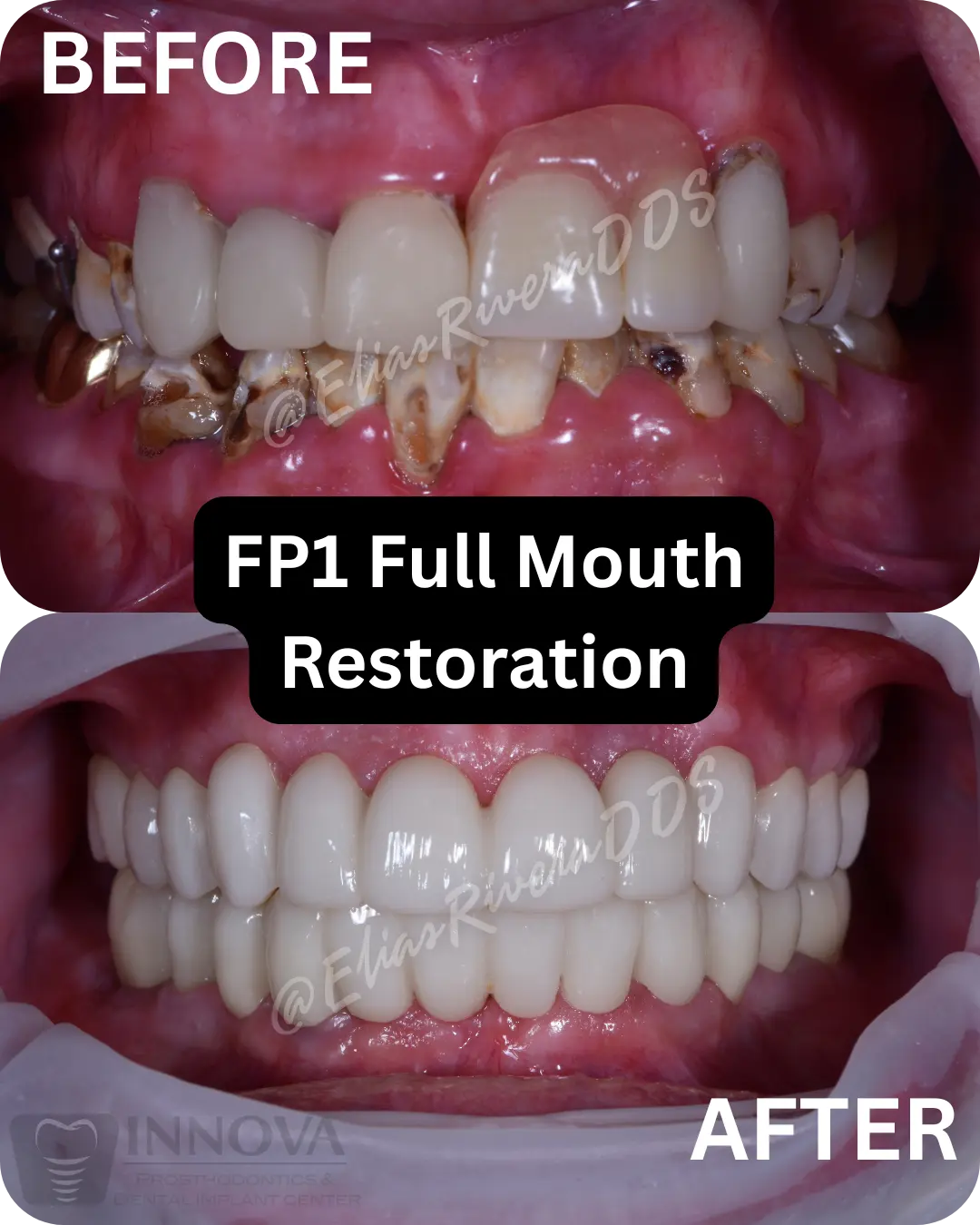 FP1-Full-Mouth-Restoration -Innova Prosthodontis _Dr-Elias-Rivera