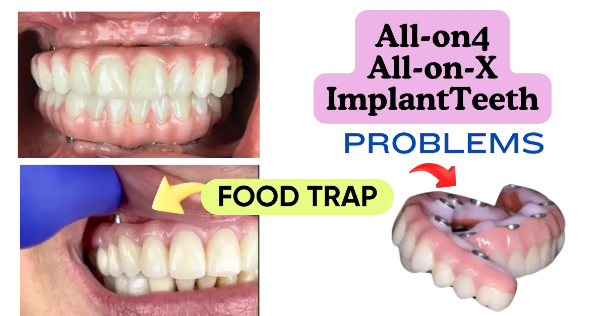 all-on-4 and all-on-x- FP3 TEETH – food trap issue all-on-4 and all-on-x- FP3 TEETH - food trap issue