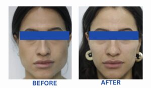 Resultados antes y después de la corrección de la sonrisa gingival con Botox en odontología en Innova Prosthodontics.