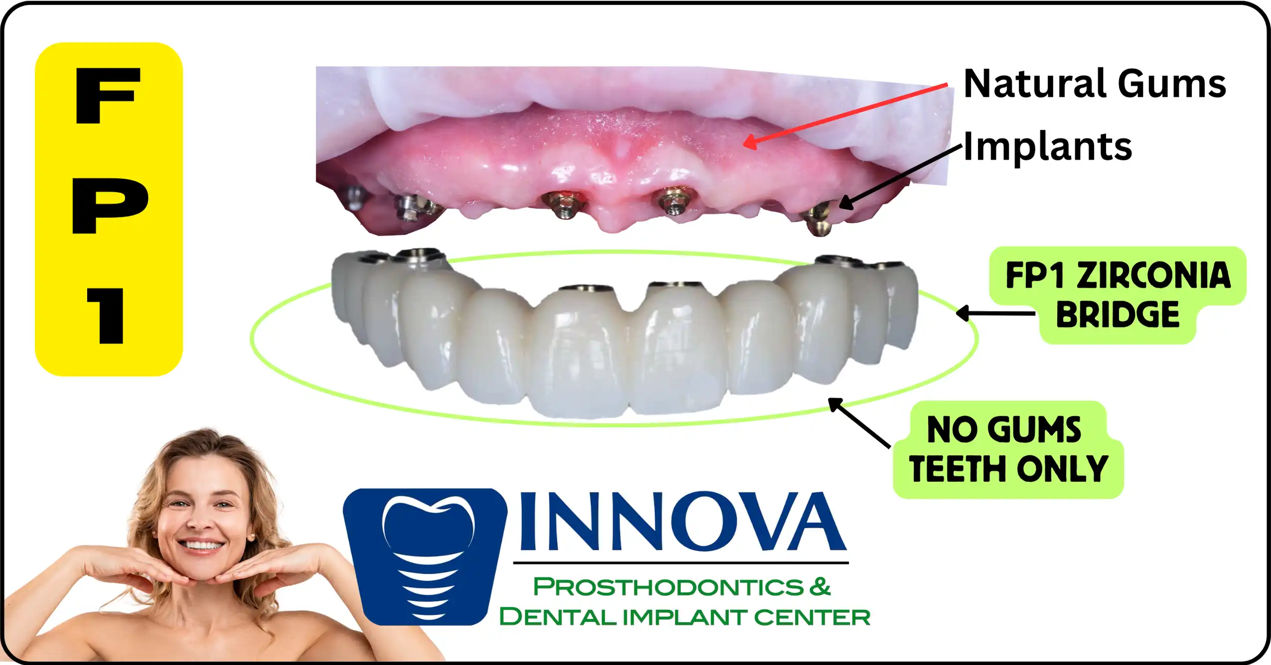 Innova-Prosthodontics-What-is-an-FP1-Full-Arch-Implant-Restoration-Bridge-