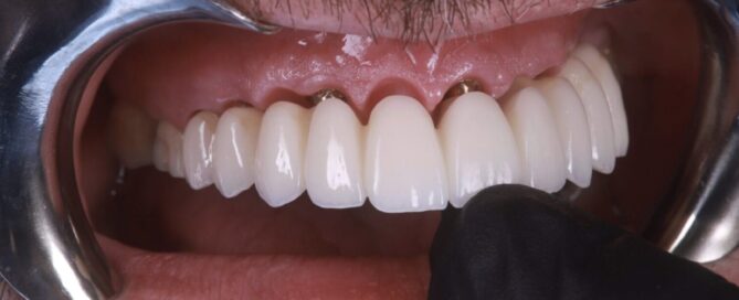 Close-up of an FP1 zirconia full-arch restoration showing natural gingival line and precision fit – Innova Prosthodontics.