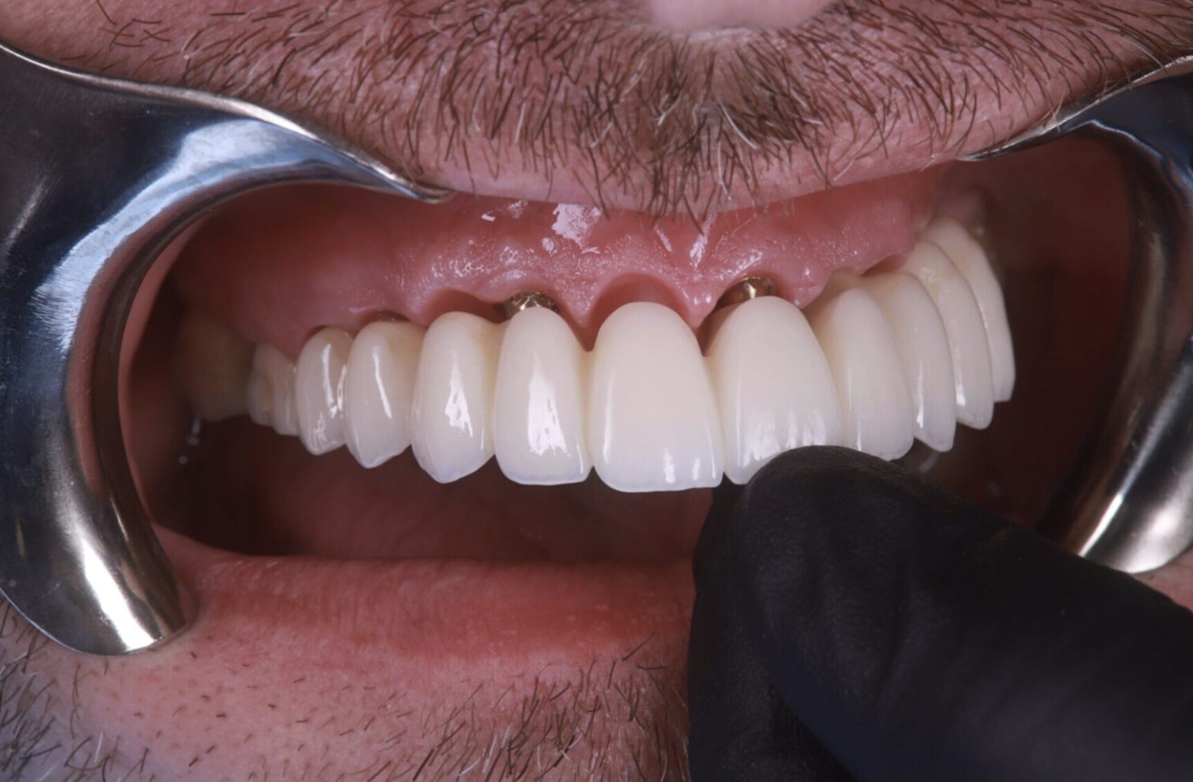 FP1 Zirconia Restoration – Natural Gum Line and Seamless Fit Close-up of an FP1 zirconia full-arch restoration showing natural gingival line and precision fit – Innova Prosthodontics.