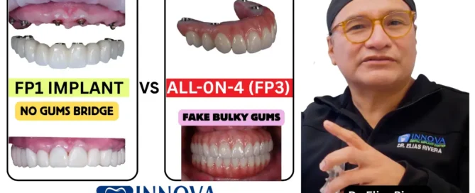 FP1s-FP3-Dental-Implants-What-Patients-Need-to-Know-Without-the-Marketing-Hype