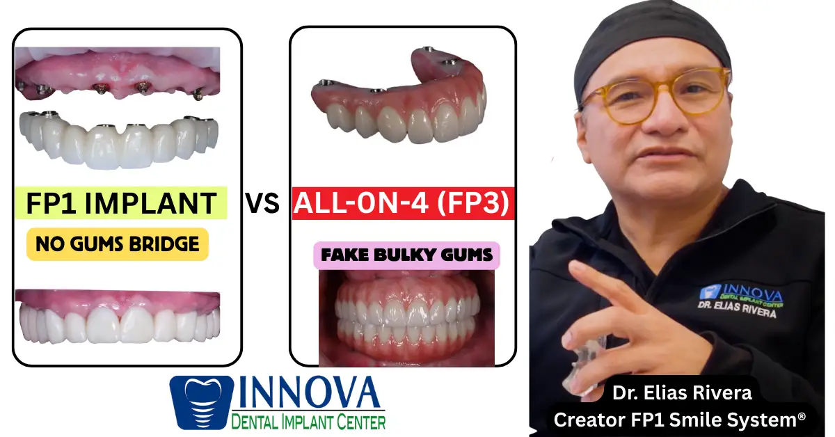 FP1s-FP3-Dental-Implants-What-Patients-Need-to-Know-Without-the-Marketing-Hype