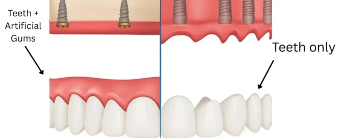 FP1 vs FP3 dental implants