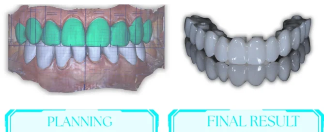 Prosthodontic-full-arch-implant-treatment-planning-with-digital-smile-design-and-final-implant-supported-FP1-prosthesis